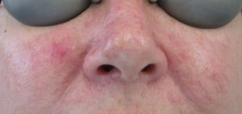 53 year old Female with Facial Veins / Telangiectasia before 694731