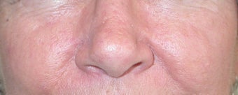 53 year old Female with Facial Veins / Telangiectasia after 694731
