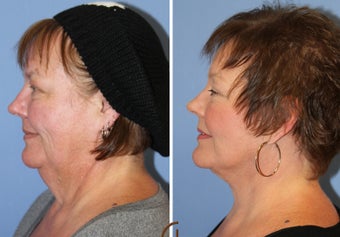 Neck lift under local anesthesia and twilight sedation after 252451
