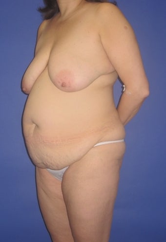 34 year old seeks tighter tummy and perky breasts before 1325058