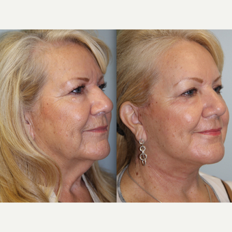 66 year old woman treated with Neck Lift before 3320116