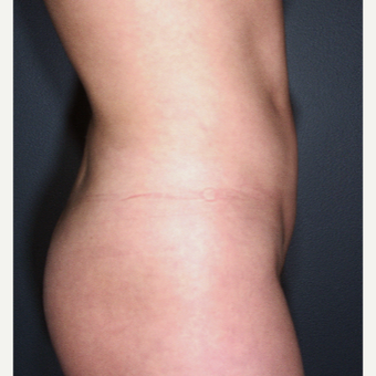 25-34 year old woman treated with Liposuction - multiple areas were treated after 3664470