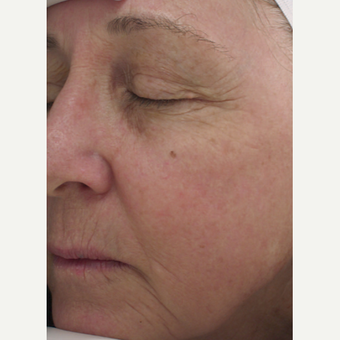 Halo Laser after 1833342