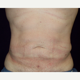 35-44 year old Male treated with Liposuction to Abdomen and Flanks after 3141995