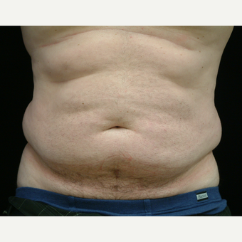 35-44 year old Male treated with Liposuction to Abdomen and Flanks before 3141995