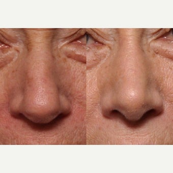 Open Rhinoplasty In Mature Patient To Improve Nasal Breathing and Nasal Aesthetics before 2585622