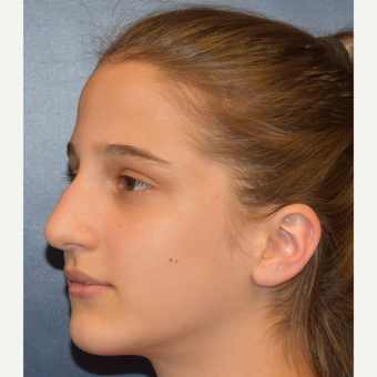 17 or under year old woman treated with Septoplasty before 3306037