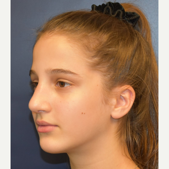 17 or under year old woman treated with Septoplasty after 3306037