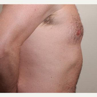 25-34 year old man treated with Male Breast Reduction after 3060353