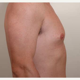 25-34 year old man treated with Male Breast Reduction before 3060353
