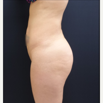 25-34 year old woman treated with Brazilian Butt Lift Revision 712cc Round Silicone Implants before 3259492