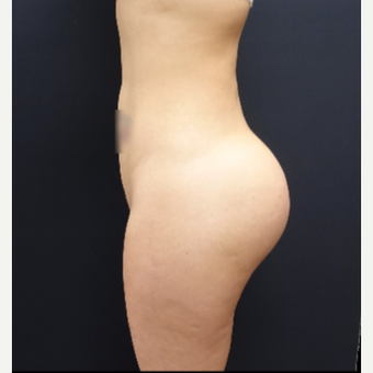 25-34 year old woman treated with Brazilian Butt Lift Revision 712cc Round Silicone Implants after 3259492