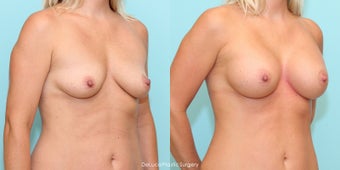 Mommy Makeover - Bilateral Dual Plane Augmentation + Mini Tummy Tuck 1498828