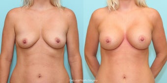 Mommy Makeover - Bilateral Dual Plane Augmentation + Mini Tummy Tuck before 1498828