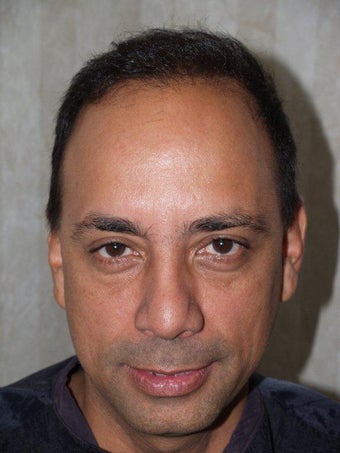 Hair Transplant - 3400 grafts after 199569