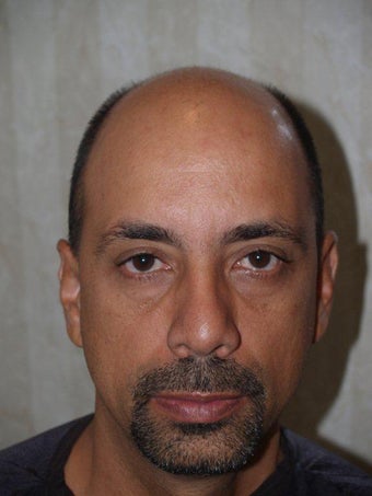 Hair Transplant - 3400 grafts before 199569