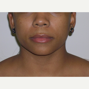 18-24 year old woman treated with Juvederm before 3547958