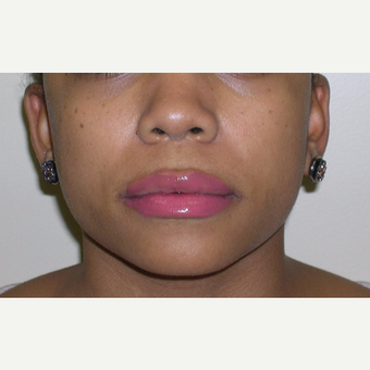 18-24 year old woman treated with Juvederm after 3547958