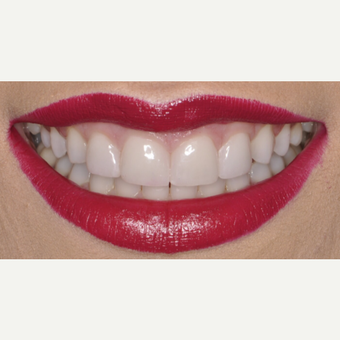 26 year old woman treated with Porcelain Veneers after 3543159