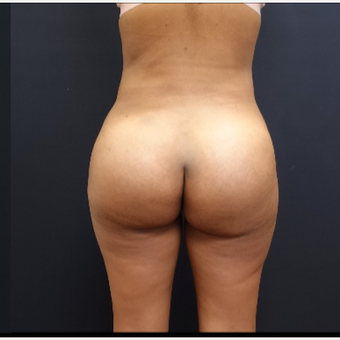 25-34 year old woman treated with Butt Implants after 3731720