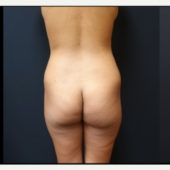 25-34 year old woman treated with Butt Implants before 3731720