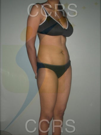 VASER lipo for body contouring 636257