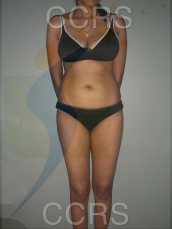 VASER lipo for body contouring before 636257