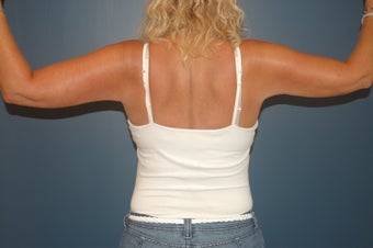 Arm lift or brachioplasty with short scar in the armpit. 1060943