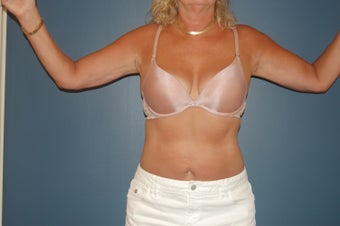 Arm lift or brachioplasty with short scar in the armpit. after 1060943