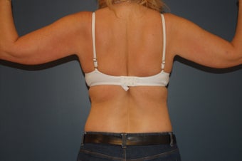 Arm lift or brachioplasty with short scar in the armpit. 1060943