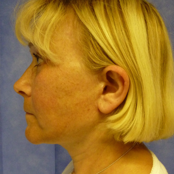 45-54 year old woman treated with Facelift after 3553821
