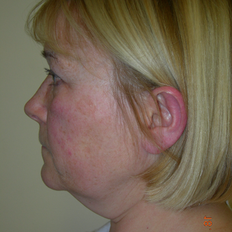 45-54 year old woman treated with Facelift before 3553821