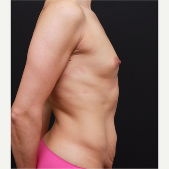 25-34 year old woman treated with Breast Augmentation before 3167759