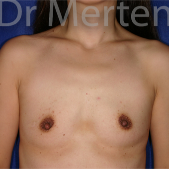 18-24 year old woman treated with Breast Augmentation before 3552616