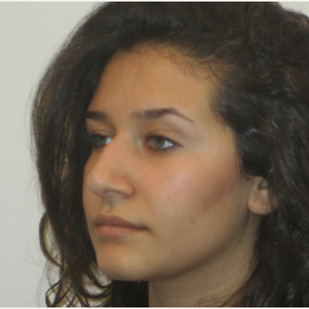 17 or under year old woman treated with Rhinoplasty before 3418738