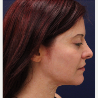 35-44 year old woman treated with Bellafill after 3142712