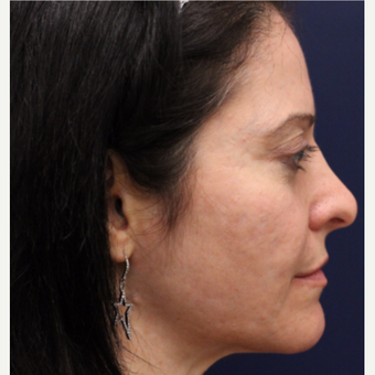 35-44 year old woman treated with Bellafill before 3142712
