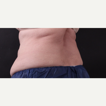 62 year old woman treated with CoolSculpting before 3221067