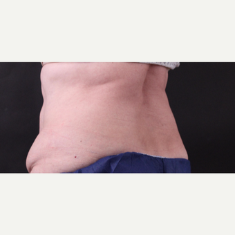 62 year old woman treated with CoolSculpting after 3221067