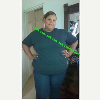 35-44 year old woman treated with Sleeve Gastrectomy before 2472996