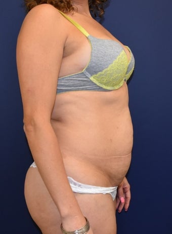 35-44 year old woman treated with Tummy Tuck before 3213937