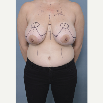 35-44 year old woman treated with Breast Reduction before 3436267