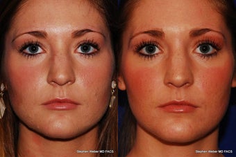 Botox before 1446457