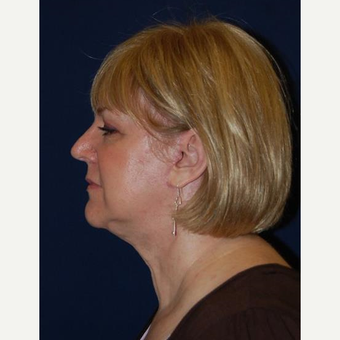 55-64 year old woman treated with Facelift after 3370692