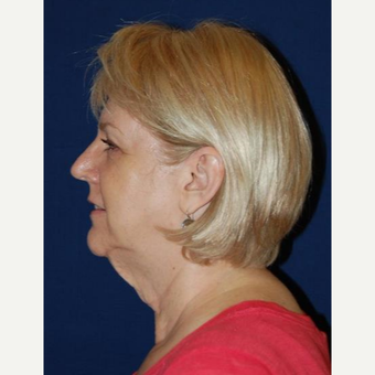55-64 year old woman treated with Facelift before 3370692
