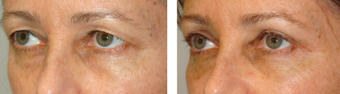 Female Brow Lift and Upper blepharoplasty before 1167828