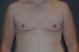 FTM Transgender after 1227458