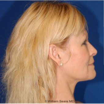 Cheek Augmentation with Natural Fat Transfer after 3104789