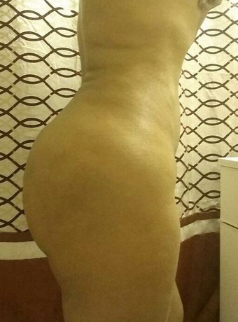 32 year old female treated for back, abdomen and buttocks lipodistrophy after 1262938