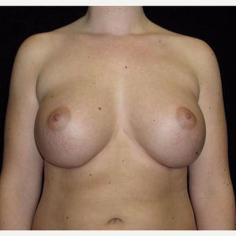 21 year old woman with asymmetry treated with Breast Augmentation after 3092590